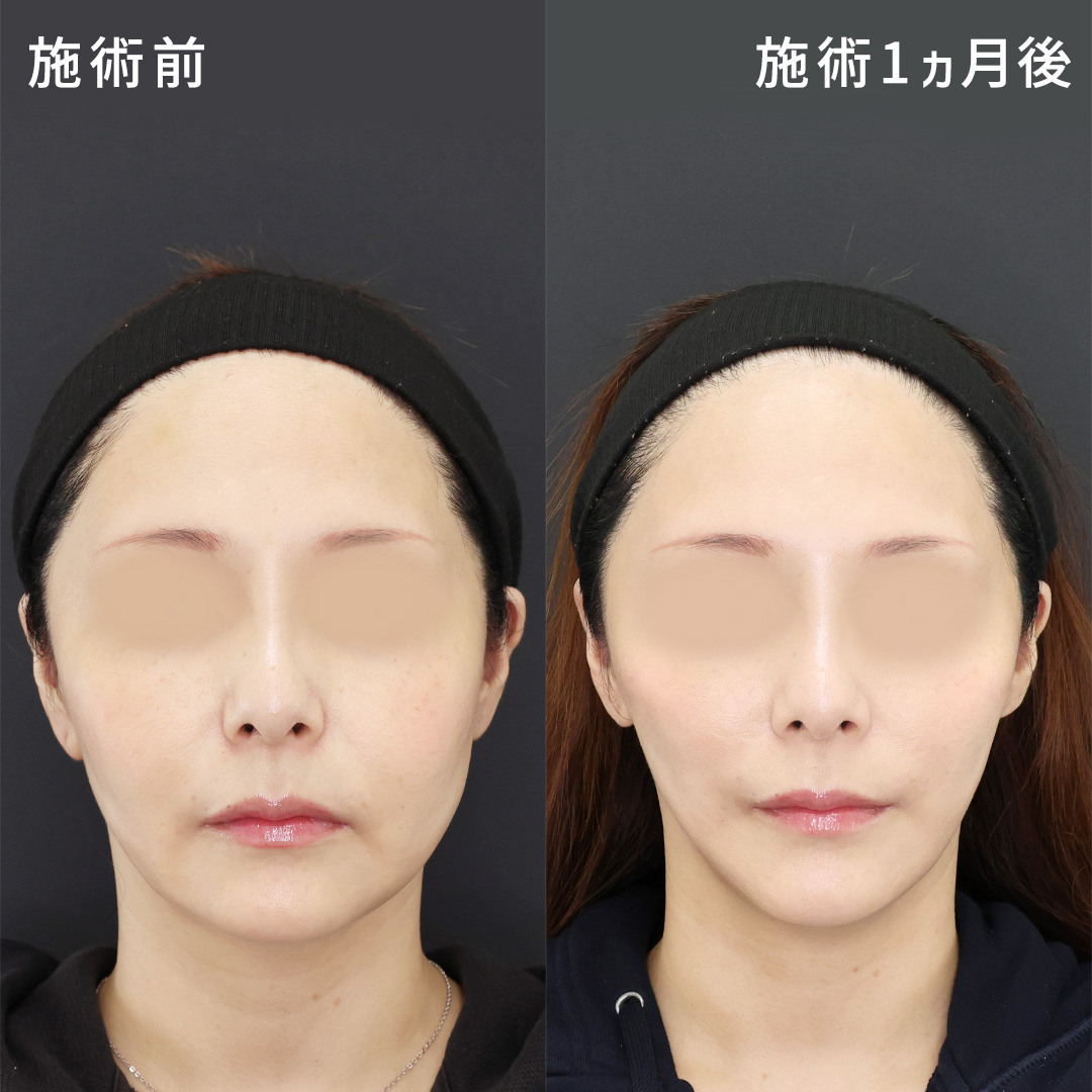 【ミドル世代も】切らずに顔痩せ