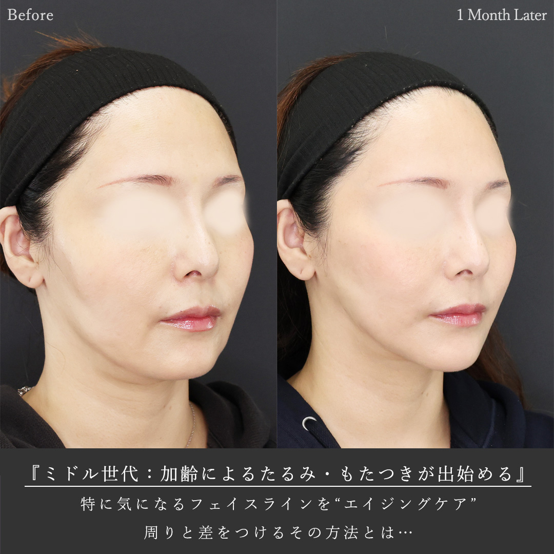 TAC式 ツヤ肌コラーゲンリフト®/ジョールファット除去/Lラインファット除去（エラ下脂肪除去）の症例写真 施術前後 