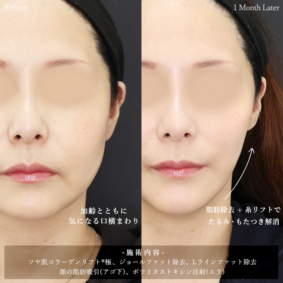 TAC式 ツヤ肌コラーゲンリフト®/ジョールファット除去/Lラインファット除去（エラ下脂肪除去）の症例写真 施術前後 