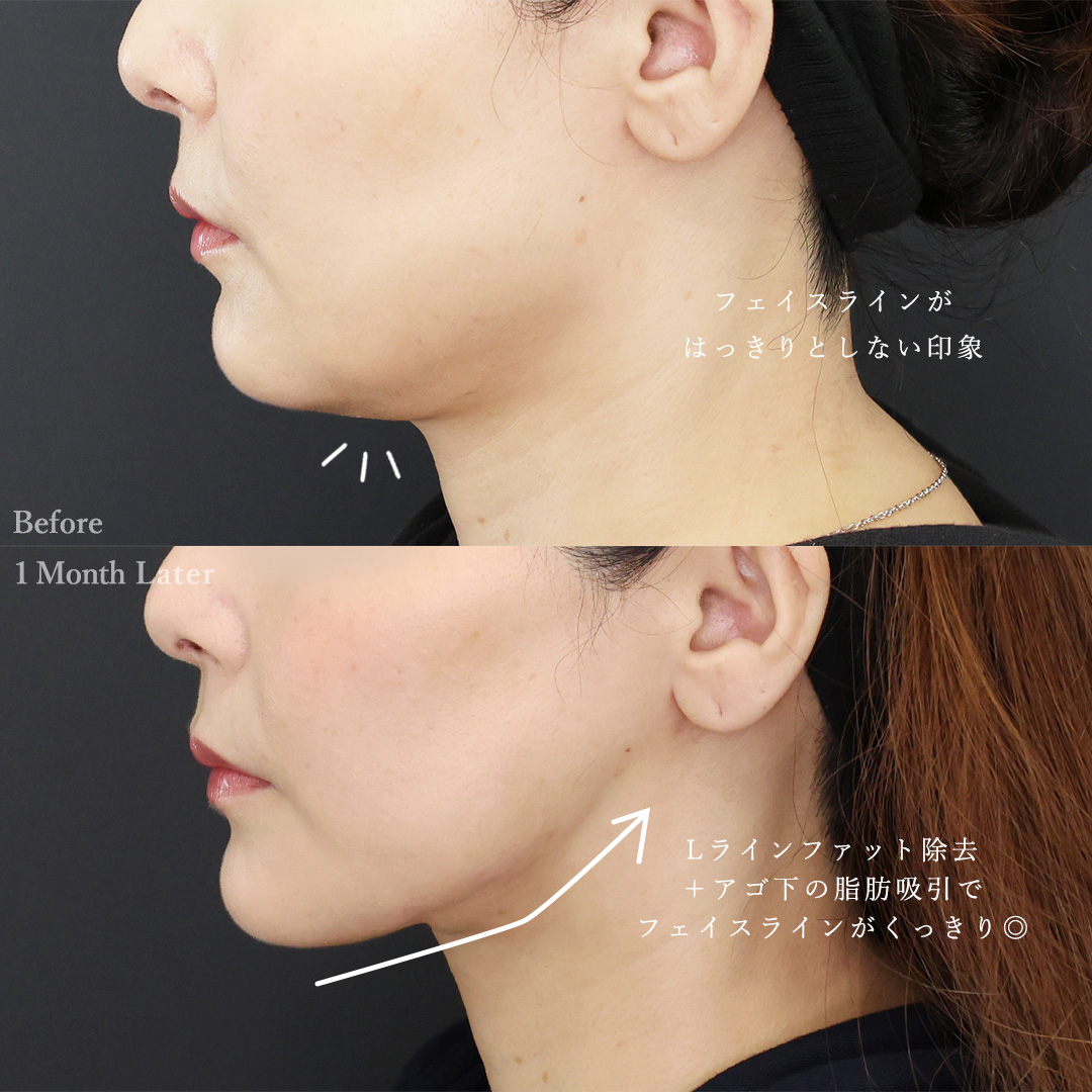 TAC式 ツヤ肌コラーゲンリフト®/ジョールファット除去/Lラインファット除去（エラ下脂肪除去）の症例写真 施術前後 