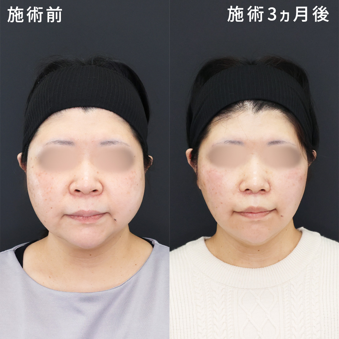 【ふたまわり以上の小顔整形】丸顔をすっきり垢抜け！！