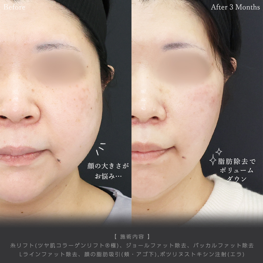 TAC式 ツヤ肌コラーゲンリフト®/ジョールファット除去/バッカルファット除去の症例写真 施術前後 