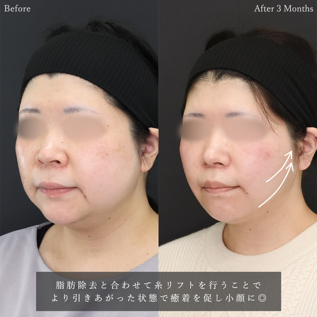 TAC式 ツヤ肌コラーゲンリフト®/ジョールファット除去/バッカルファット除去の症例写真 施術前後 