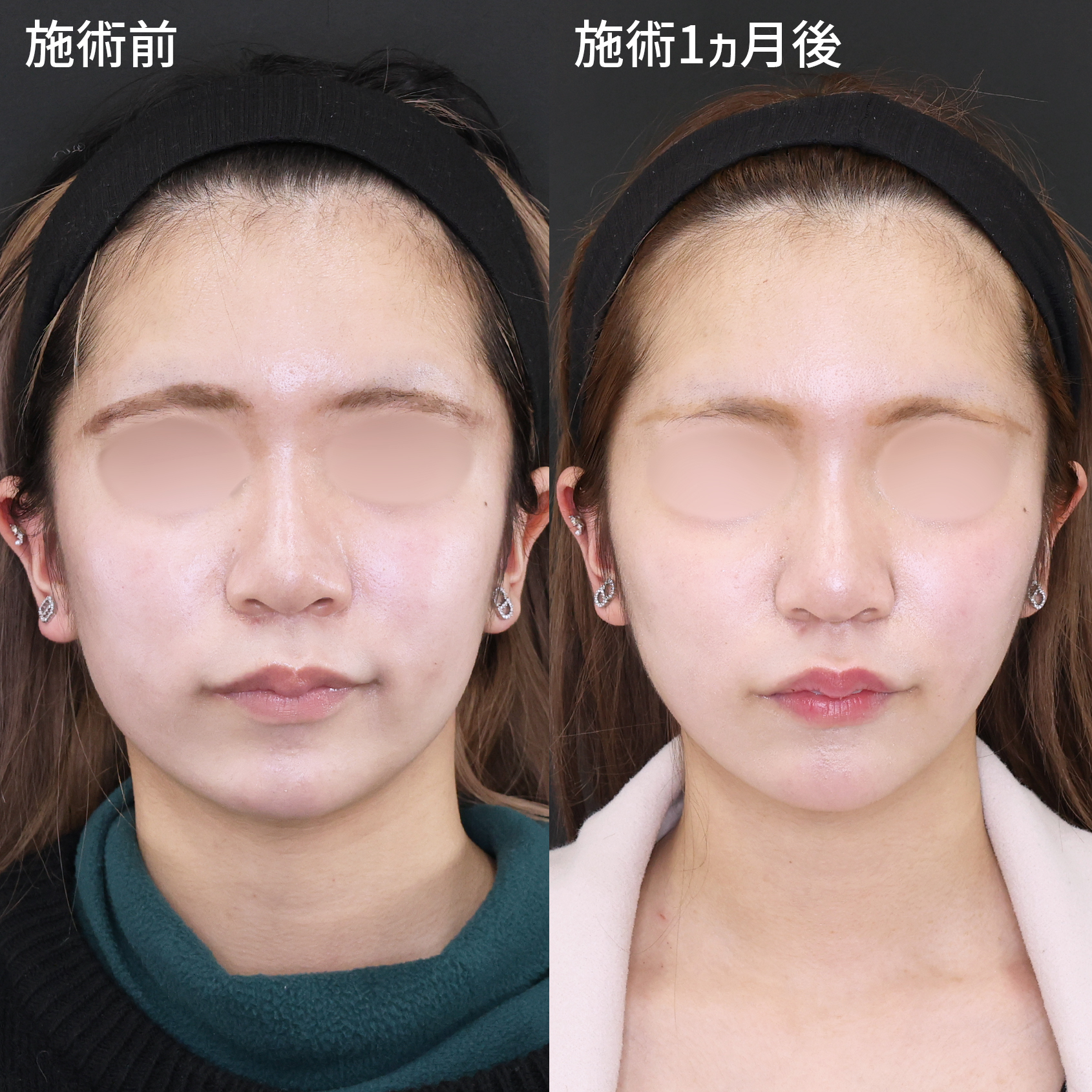 【脂肪吸引×糸リフト】悩みの箇所へピンポイントでアプローチ◎【モテ小顔術】