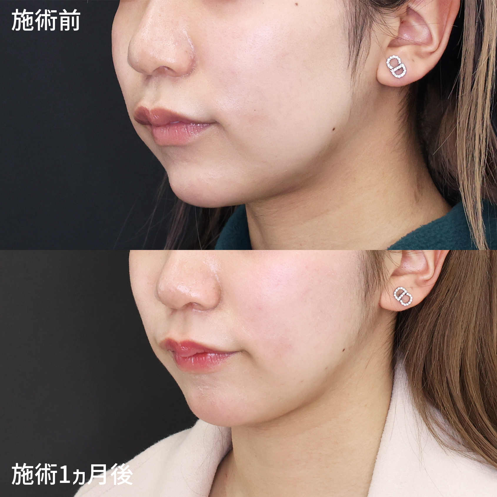 TAC式 ショッピングリフト/顔の脂肪吸引/エラボトックス注射の症例写真 施術前後 