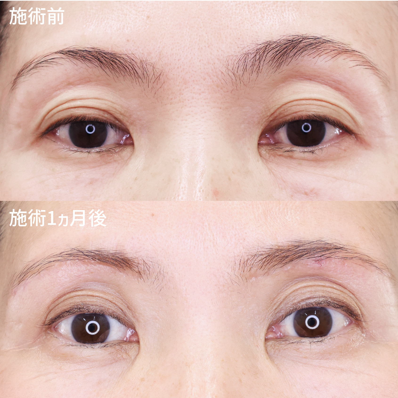 眉毛下切開術の症例写真 施術前後
