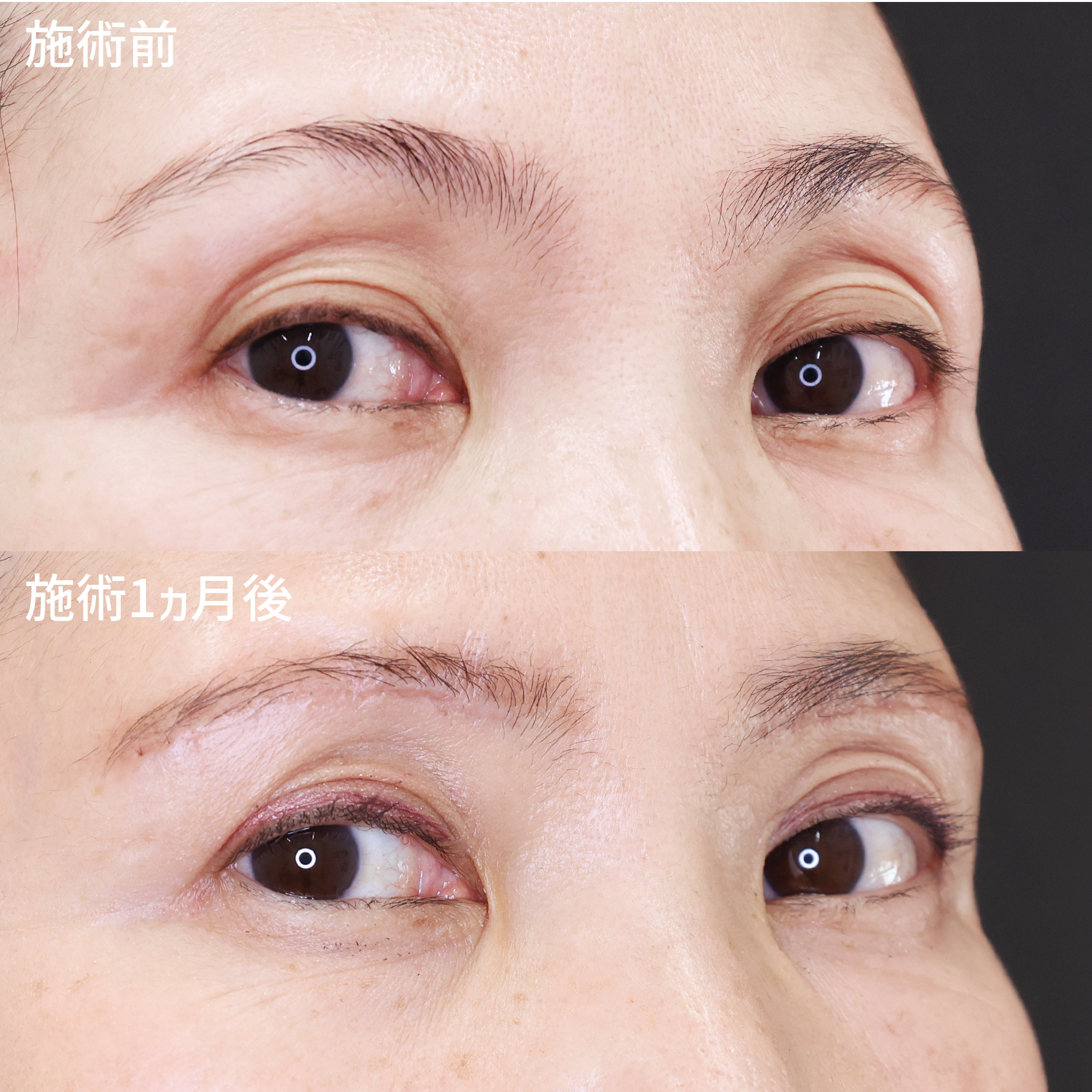 眉毛下切開術の症例写真 施術前後