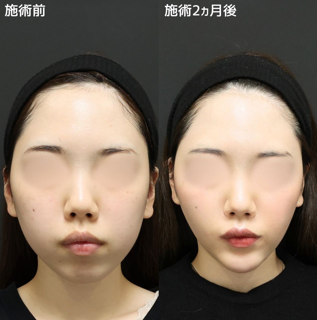 《小顔整形》理想の輪郭で人生変えませんか？