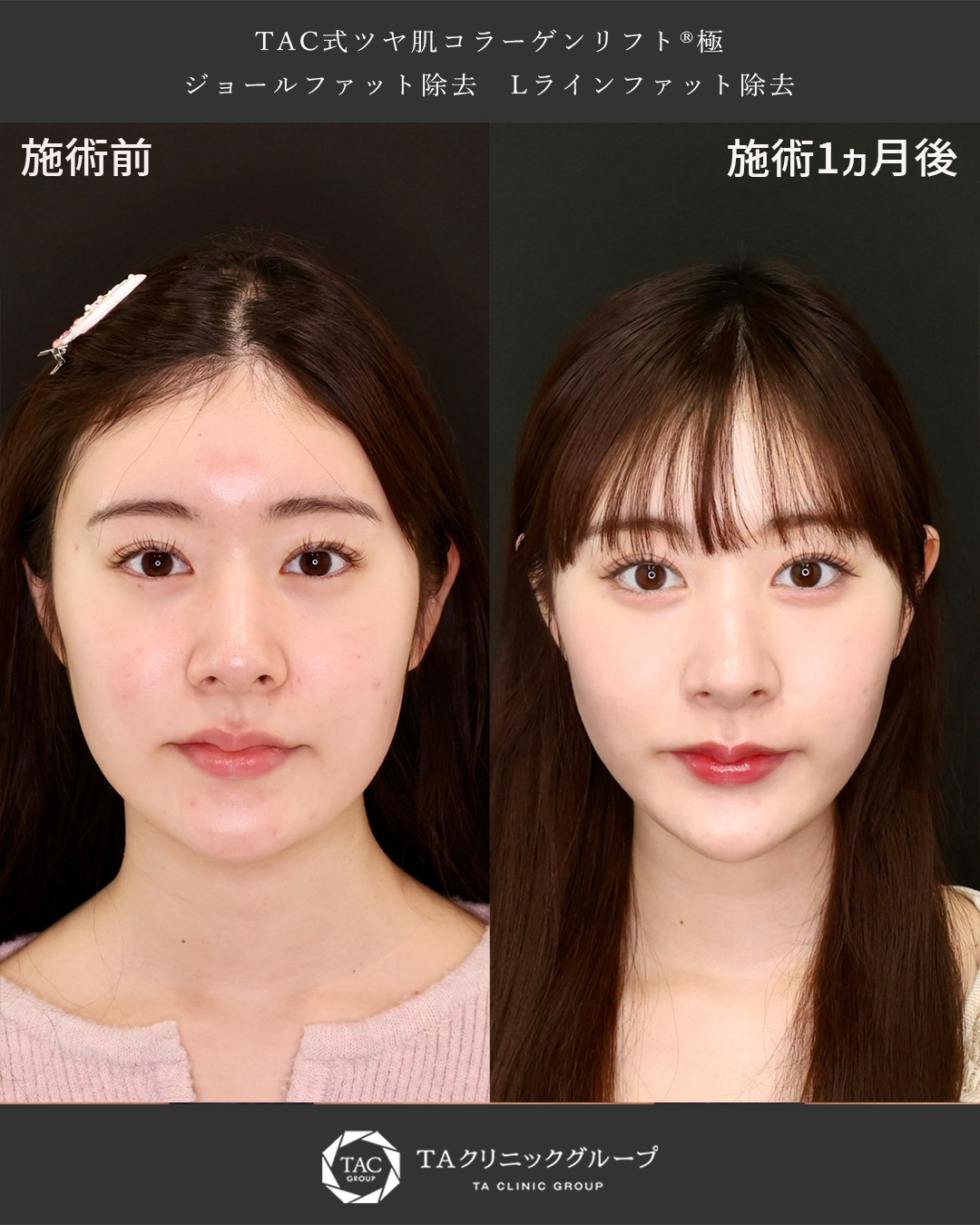 TAC式 ツヤ肌コラーゲンリフト®/ジョールファット除去/Lラインファット除去（エラ下脂肪除去）の症例写真 施術前後 