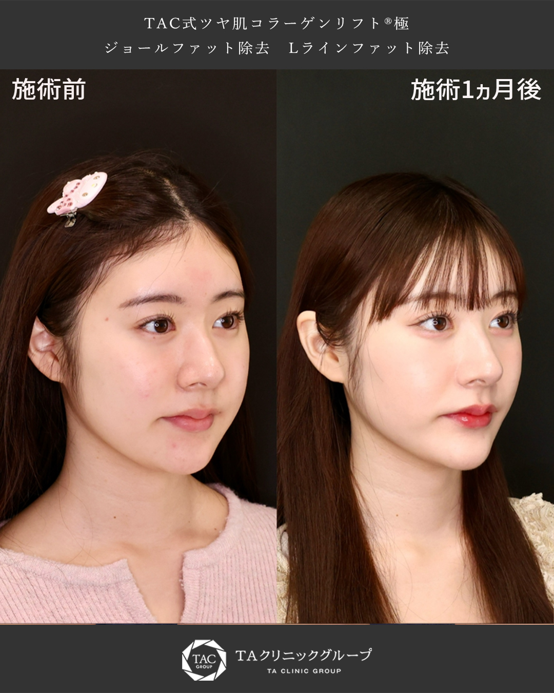 TAC式 ツヤ肌コラーゲンリフト®/ジョールファット除去/Lラインファット除去（エラ下脂肪除去）の症例写真 施術前後 