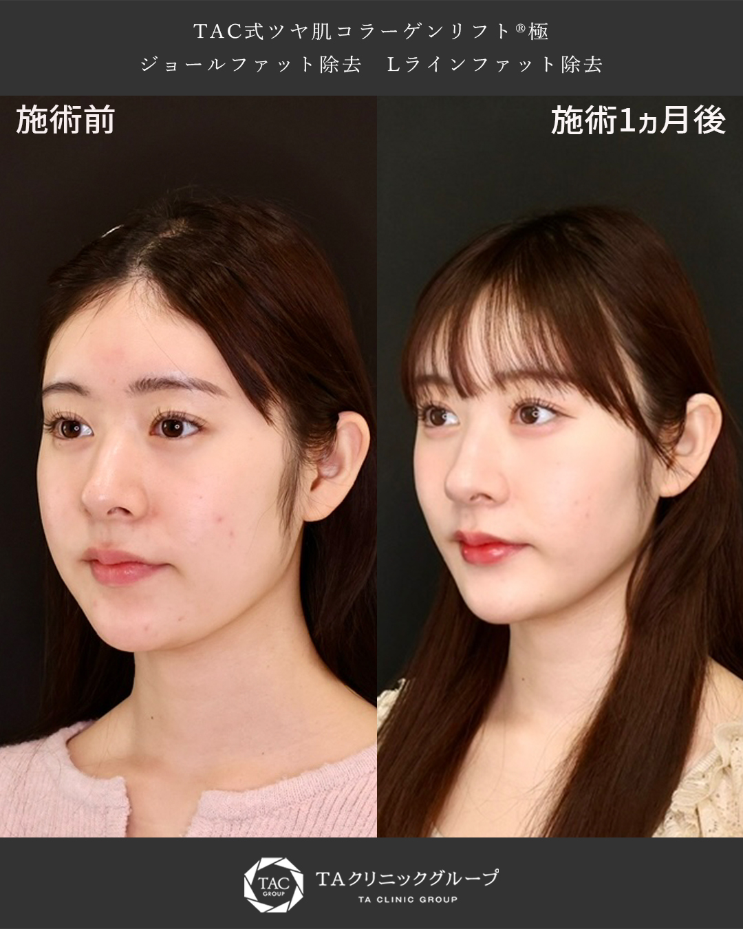 加藤美南さんが顔の脂肪吸引と糸リフトでスッキリしたフェイスラインに！小顔整形ならDr.もりもりにお任せください！