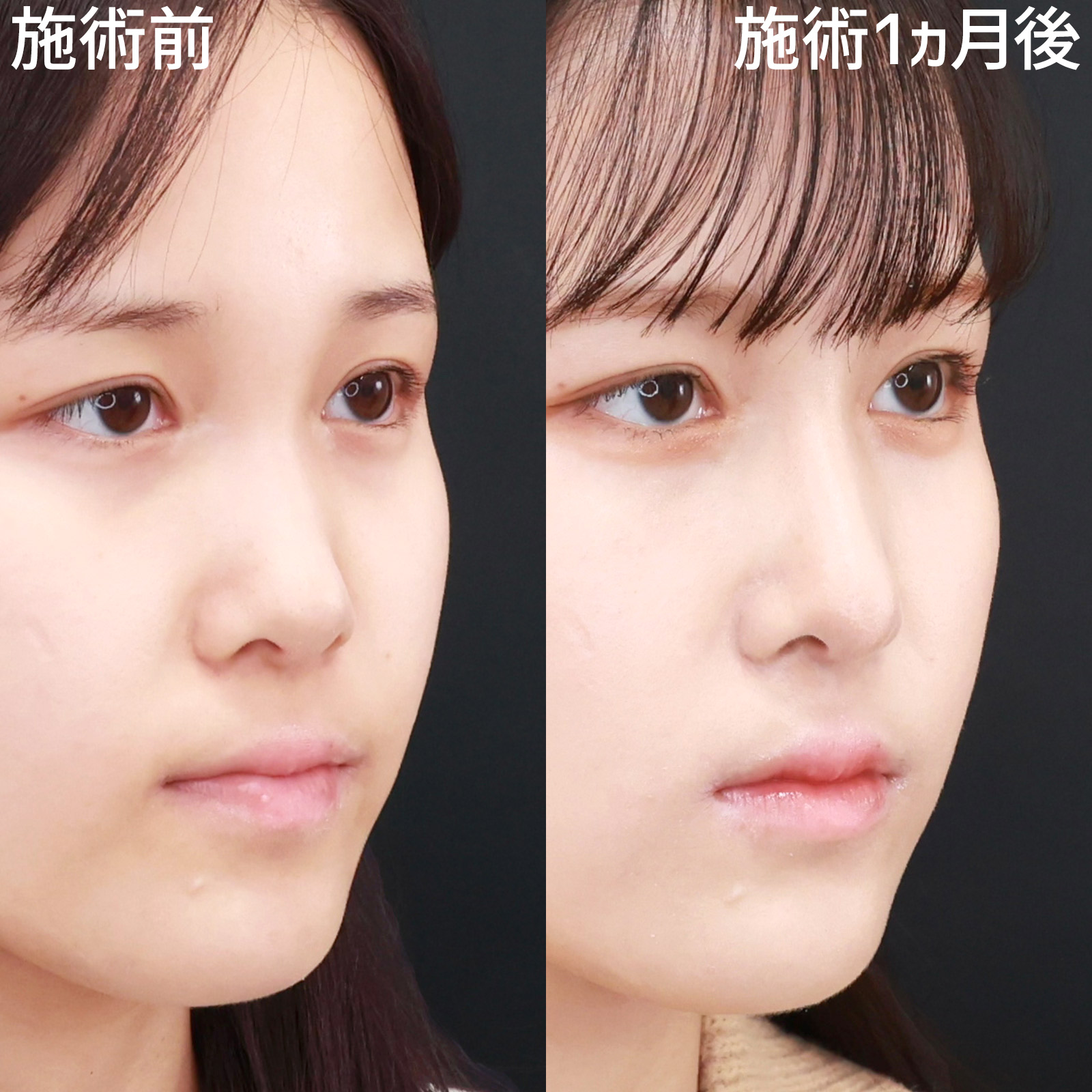 【整形感なし】ナチュラルな仕上がりでバレずに垢抜け！Dr.もりもりの鼻整形