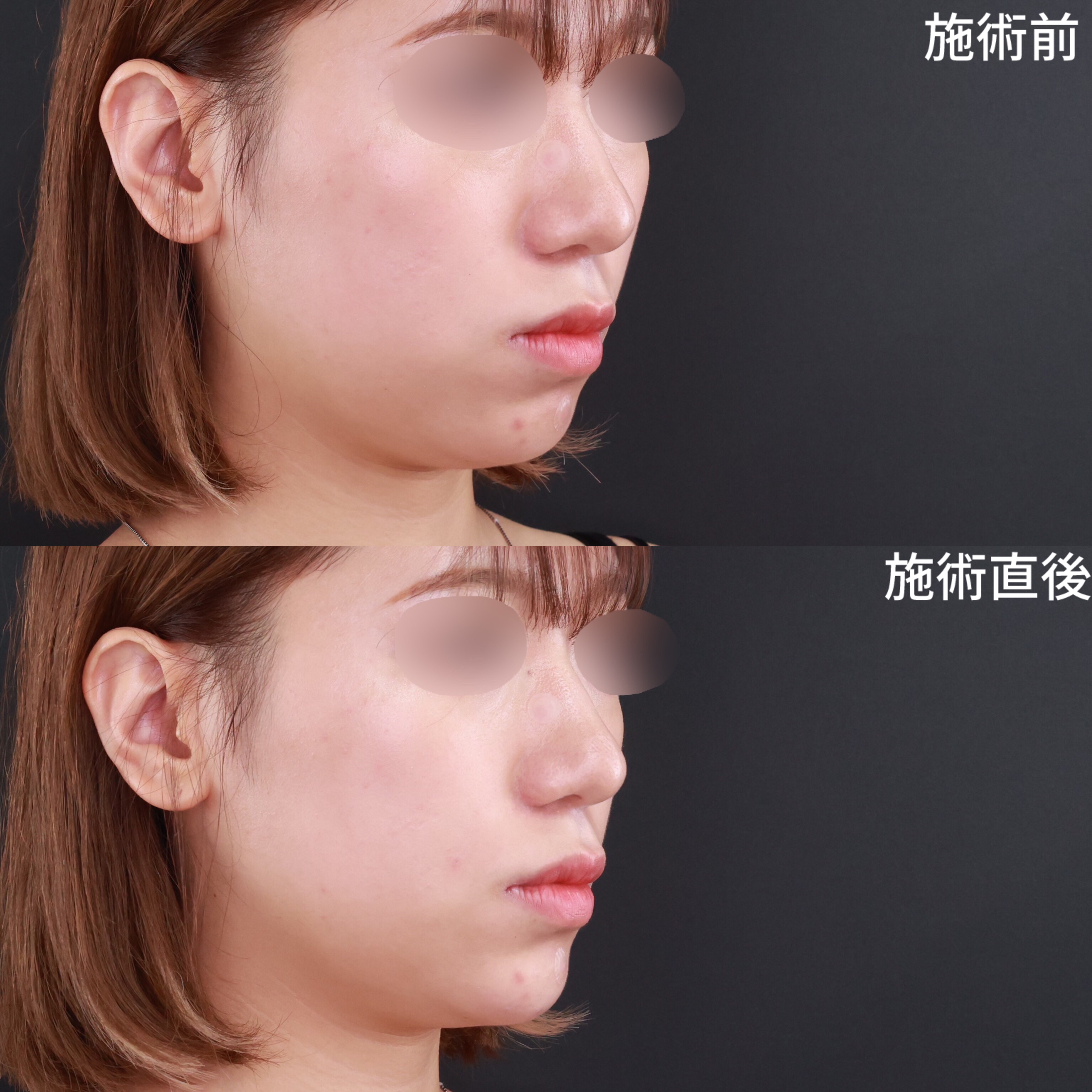 【顎・ほうれい線ヒアルロン酸注射】Eラインが整い横顔美人へ！