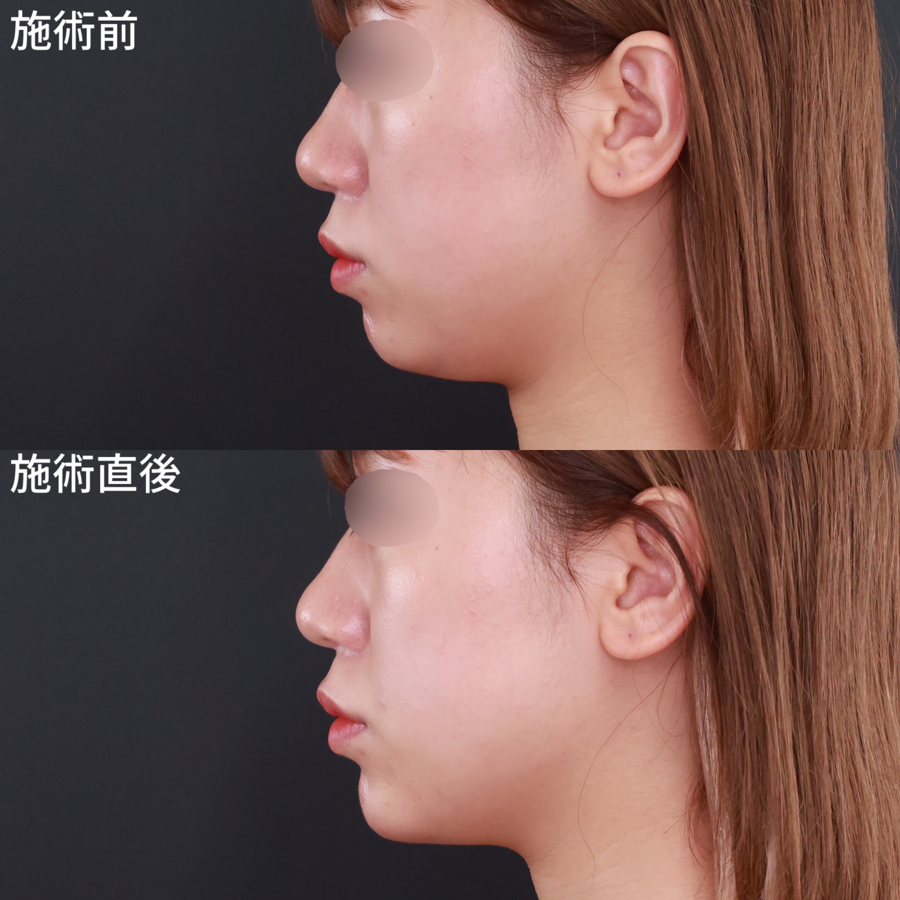 顎のヒアルロン酸注射/ほうれい線のヒアルロン酸注射の症例写真 施術前後 