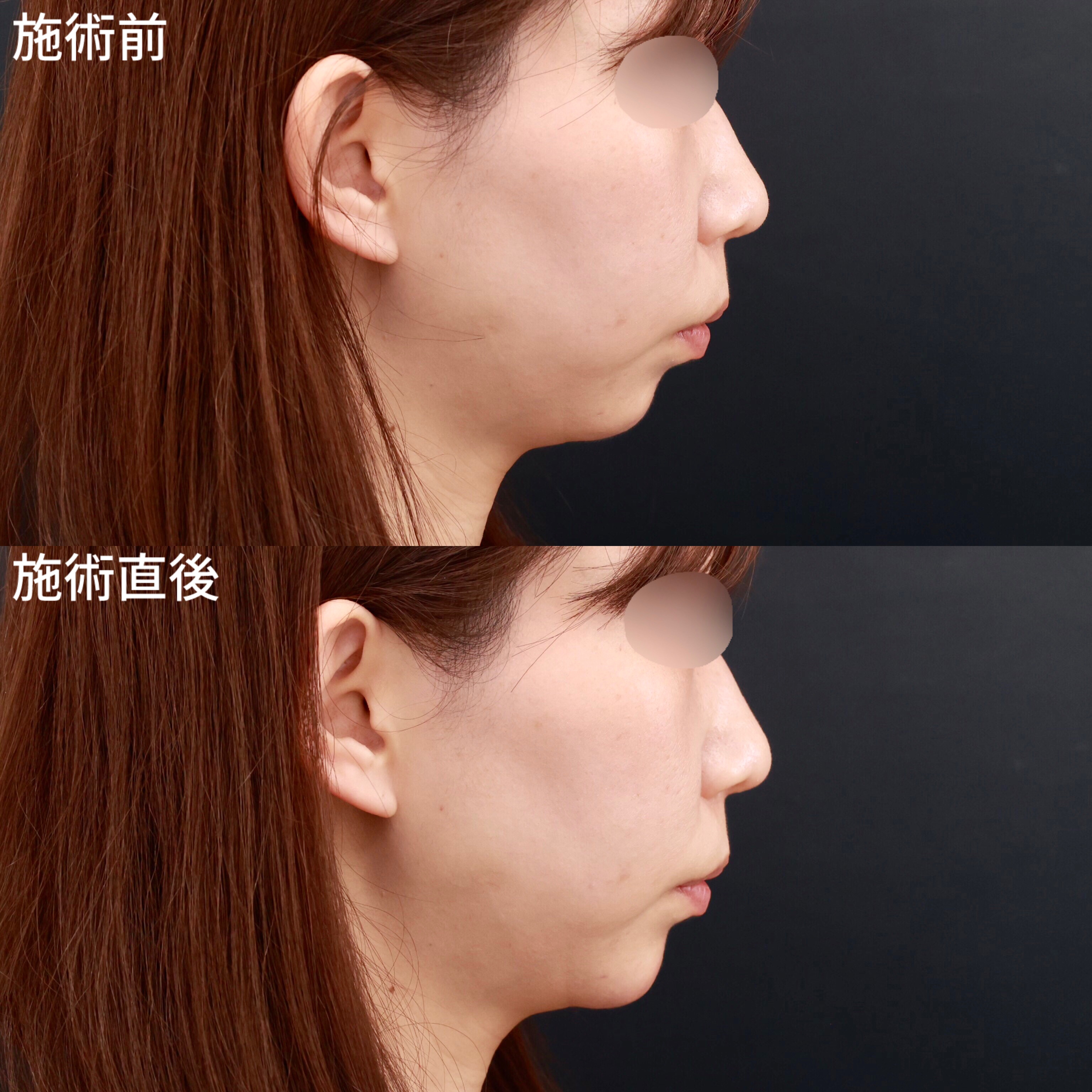 顎のヒアルロン酸注射/ボトックス注射：その他の症例写真 施術前後 