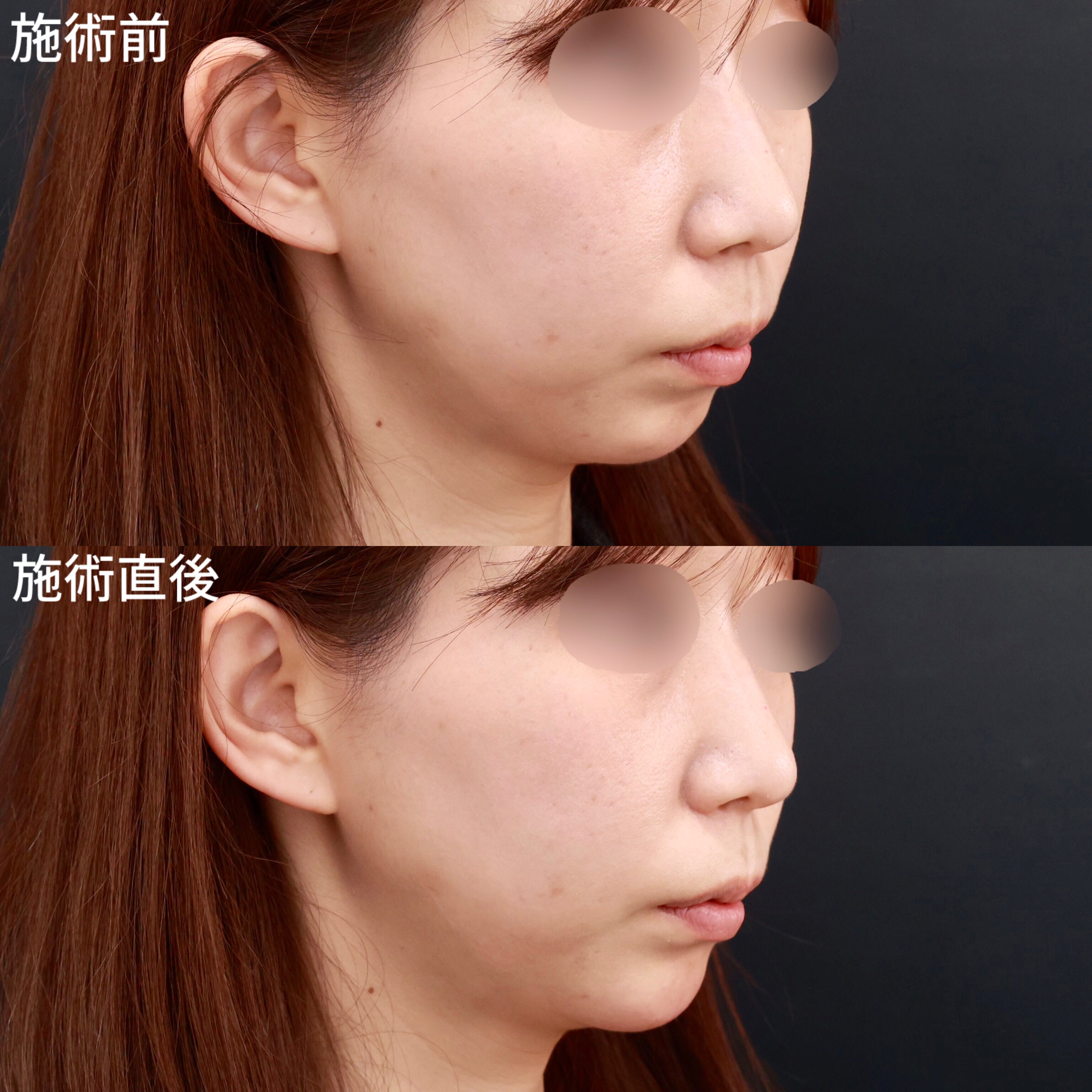 【ヒアルロン酸注射】アゴの後退を改善し綺麗な横顔に！