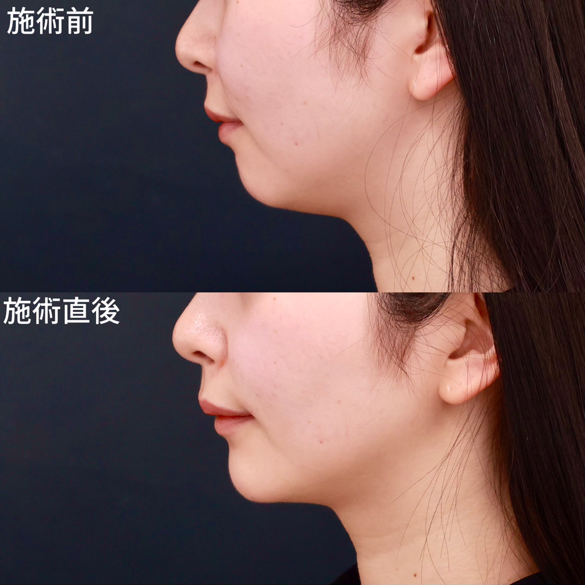 【ヒアルロン酸注射】横顔をより綺麗に美しく