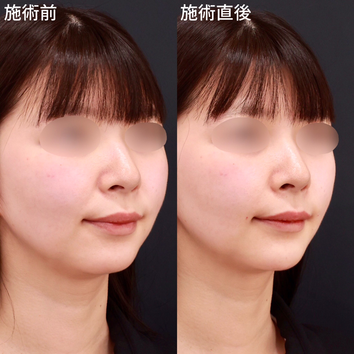 ほうれい線のヒアルロン酸注射/顎のヒアルロン酸注射の症例写真 施術前後 