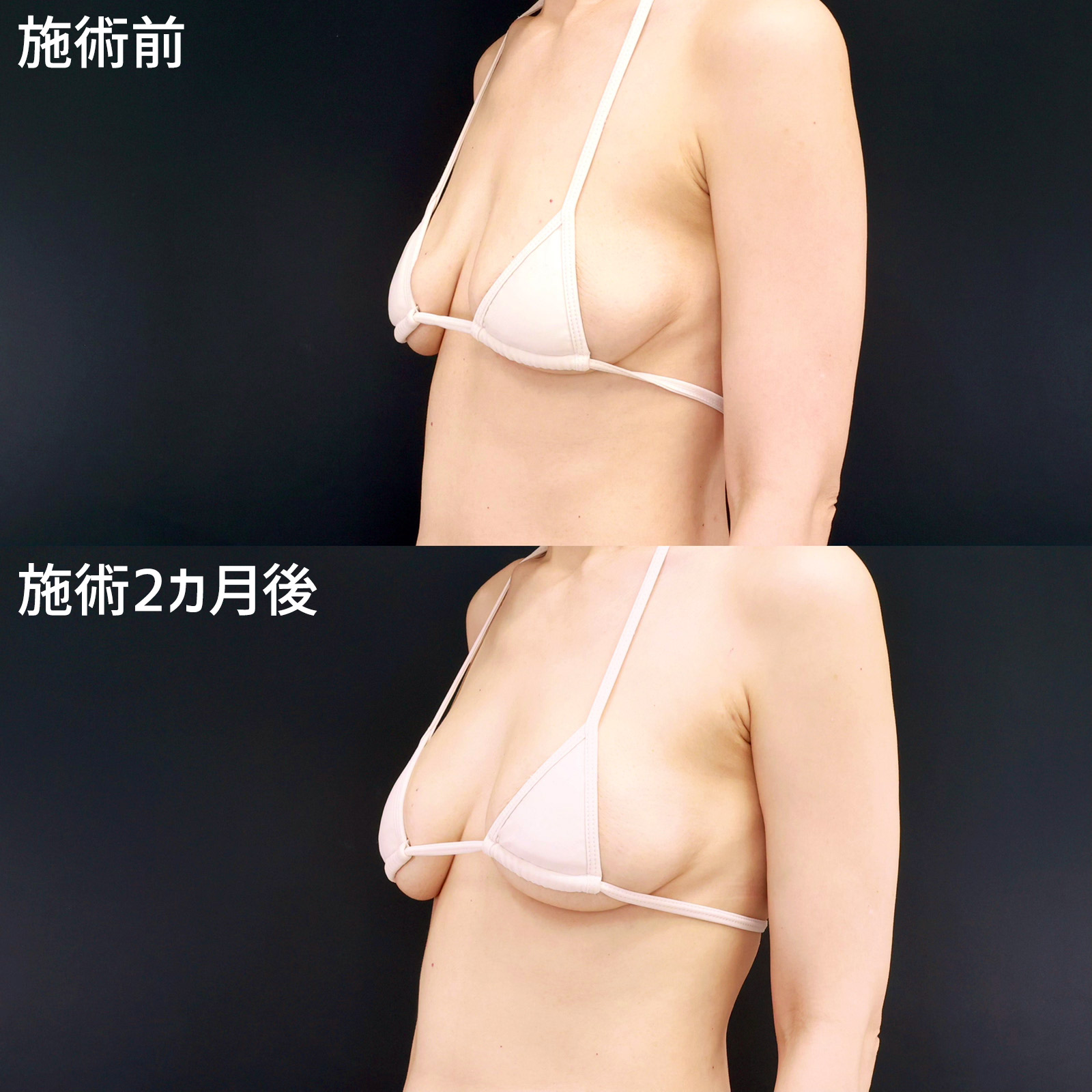 【ヒアルロン酸豊胸】たった数分で凹みを解消!お手軽なバストメイクならヒアルロン酸豊胸術
