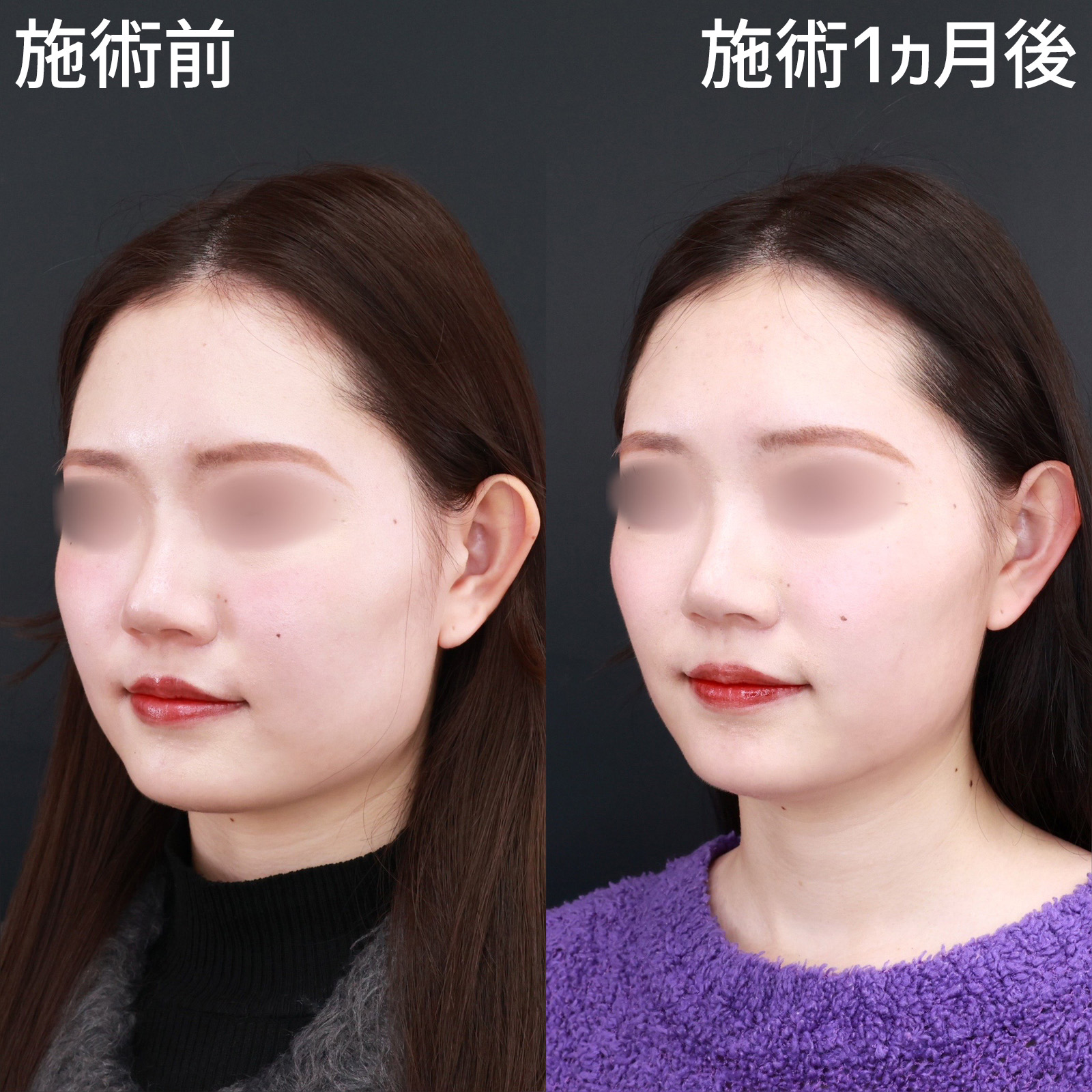 エラボトックス注射の症例写真 施術前後 