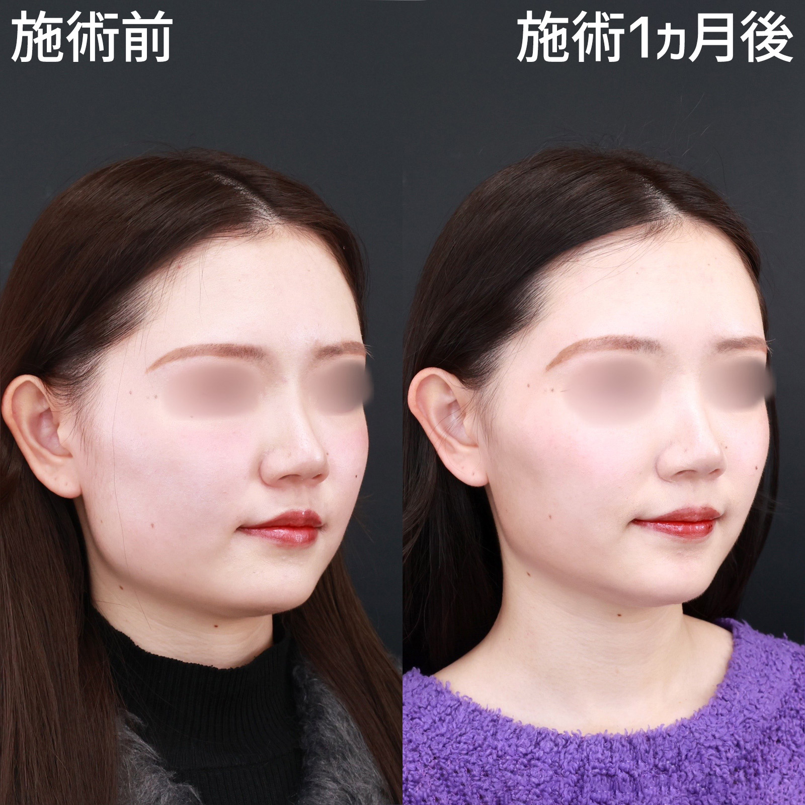 エラボトックス注射の症例写真 施術前後 