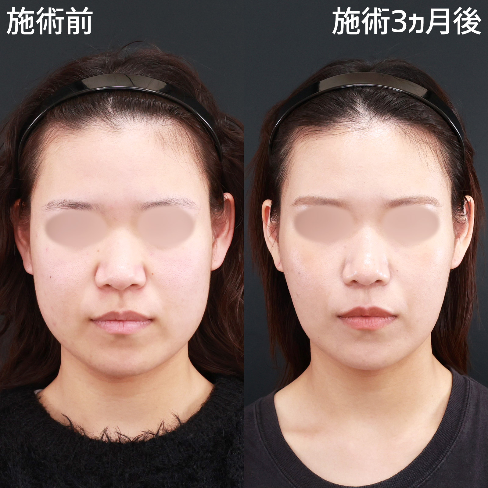 【糸リフト＆頬脂肪吸引】気になる頬のふくらみを解消して、お顔を一回り小さく！