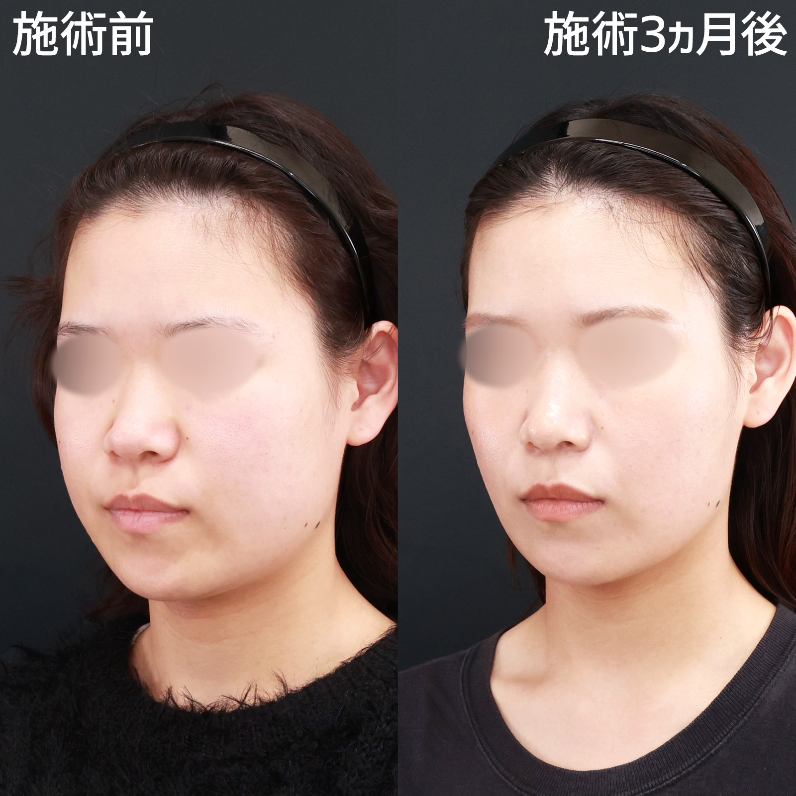 小顔整形｜パーフェクトフェイスライン/TAC式 ツヤ肌コラーゲンリフト®/エラボトックス注射の症例写真 施術前後 