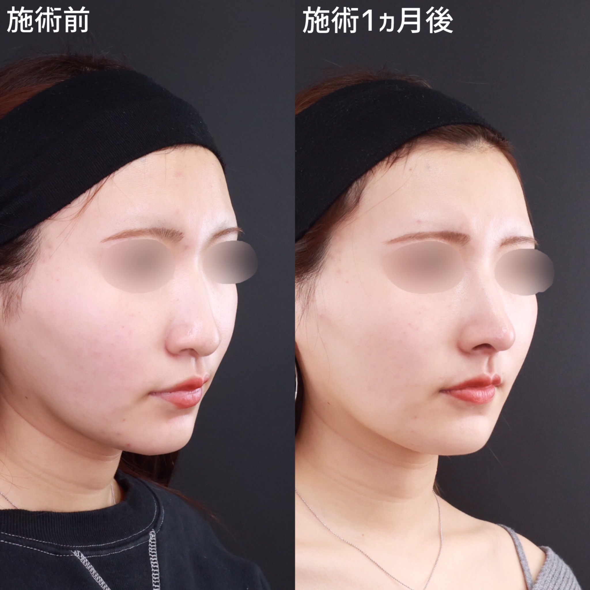 鼻中隔延長術/鼻先軟骨移植/鼻尖形成・鼻尖縮小の症例写真 施術前後