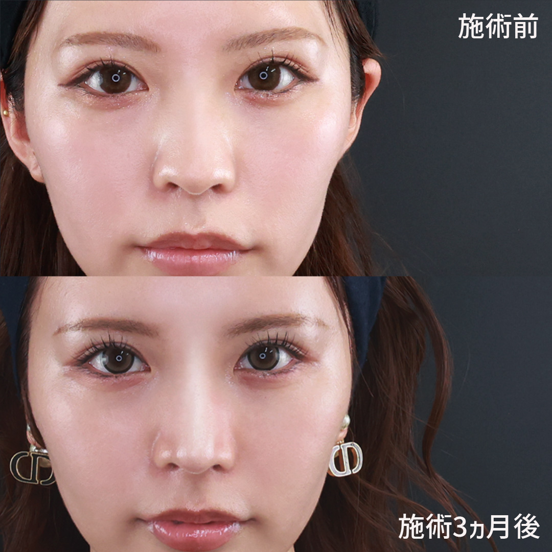 【福岡鼻整形のプロフェッショナルが執刀】綺麗なS字ラインで横顔も整う「忘れ鼻」に