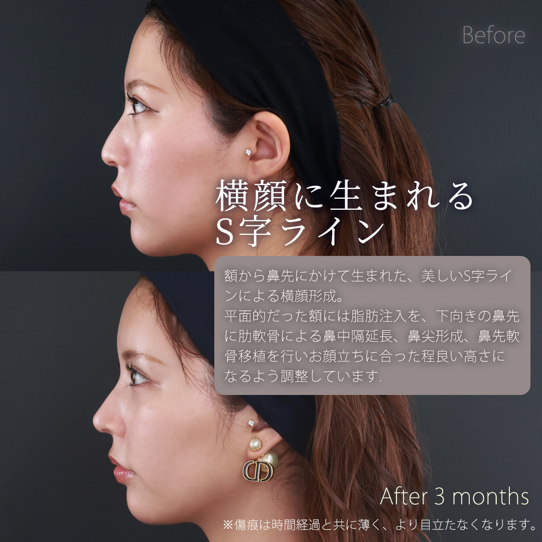 鼻中隔延長術/鼻先軟骨移植/鼻尖形成・鼻尖縮小の症例写真 施術前後 