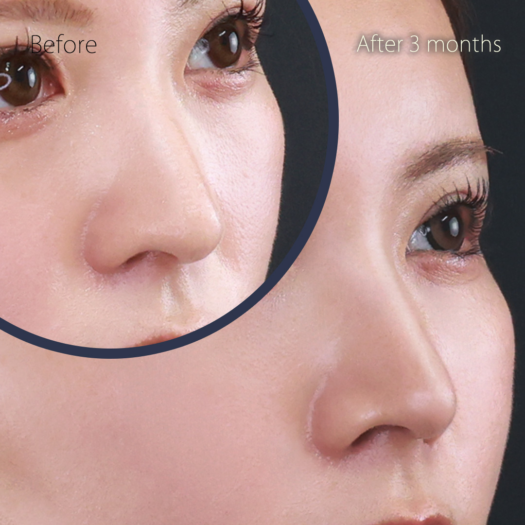 鼻中隔延長術/鼻先軟骨移植/鼻尖形成・鼻尖縮小の症例写真 施術前後 