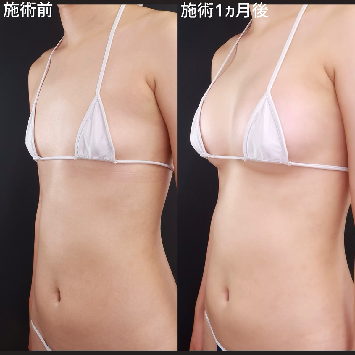 【シリコンバッグ豊胸】ハイブリッド豊胸でバストのボリューム感UPと自然な触り心地を実現!