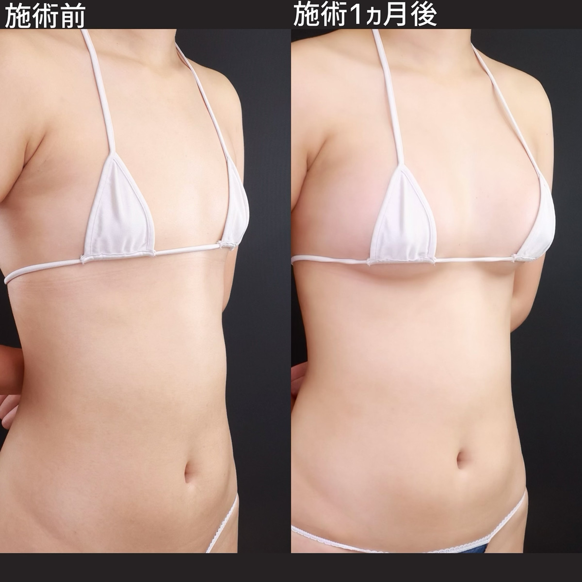 シリコンバッグ豊胸（人工乳腺バッグ）の症例写真 施術前後 