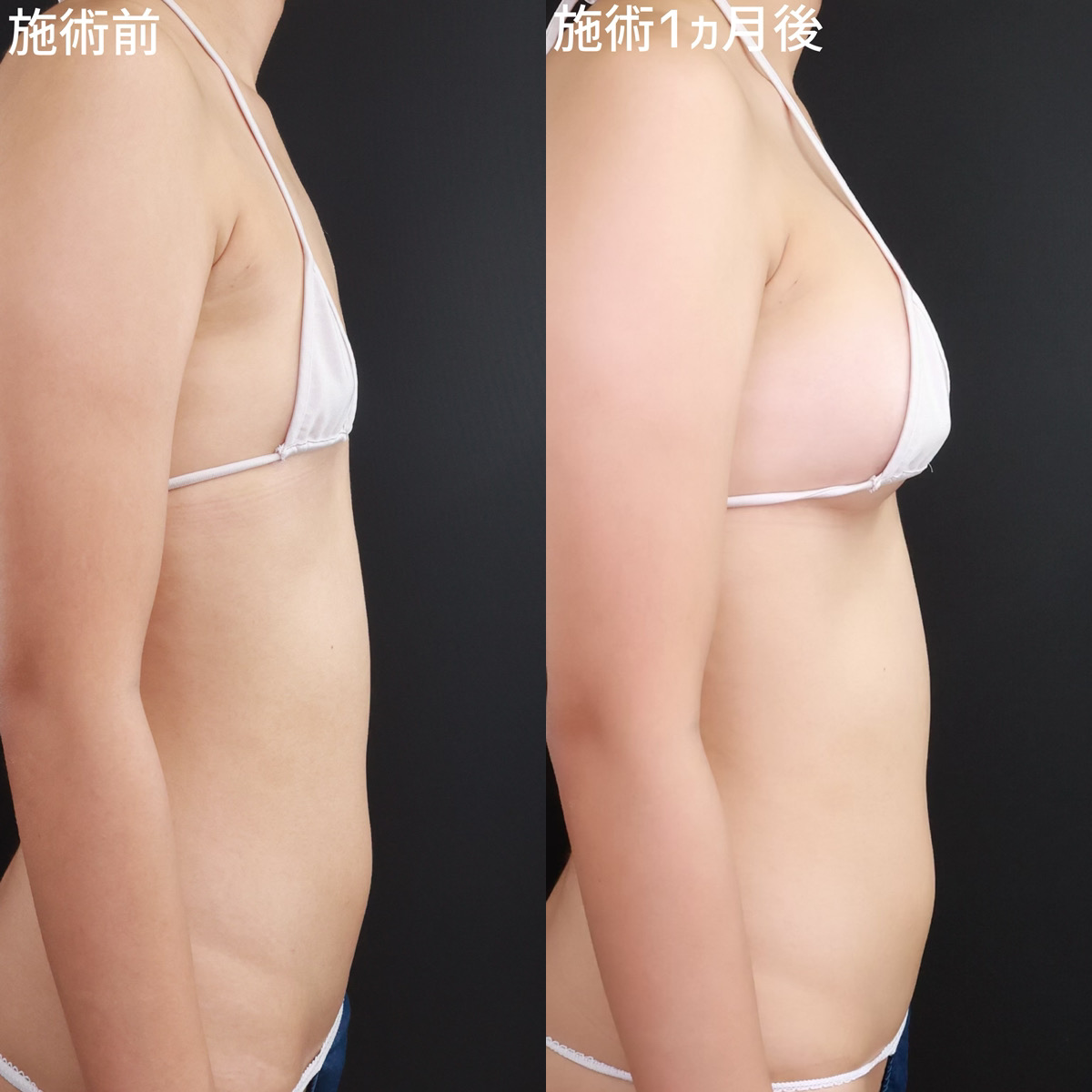 シリコンバッグ豊胸（人工乳腺バッグ）の症例写真 施術前後 