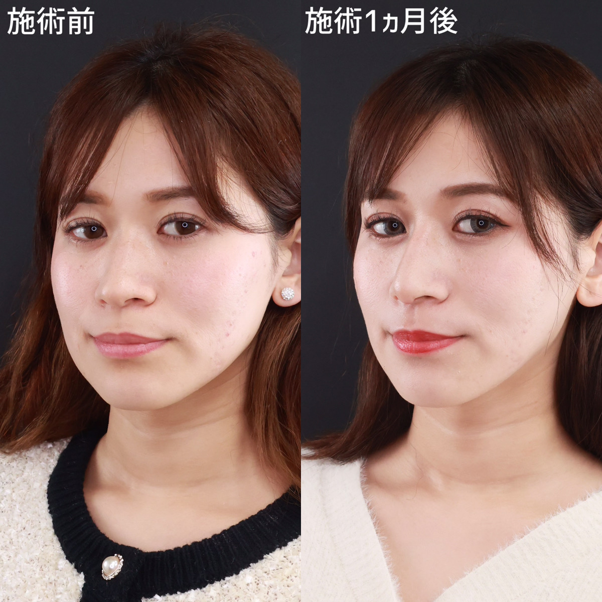 【鼻フル整形】自然な高さで理想の鼻を叶える