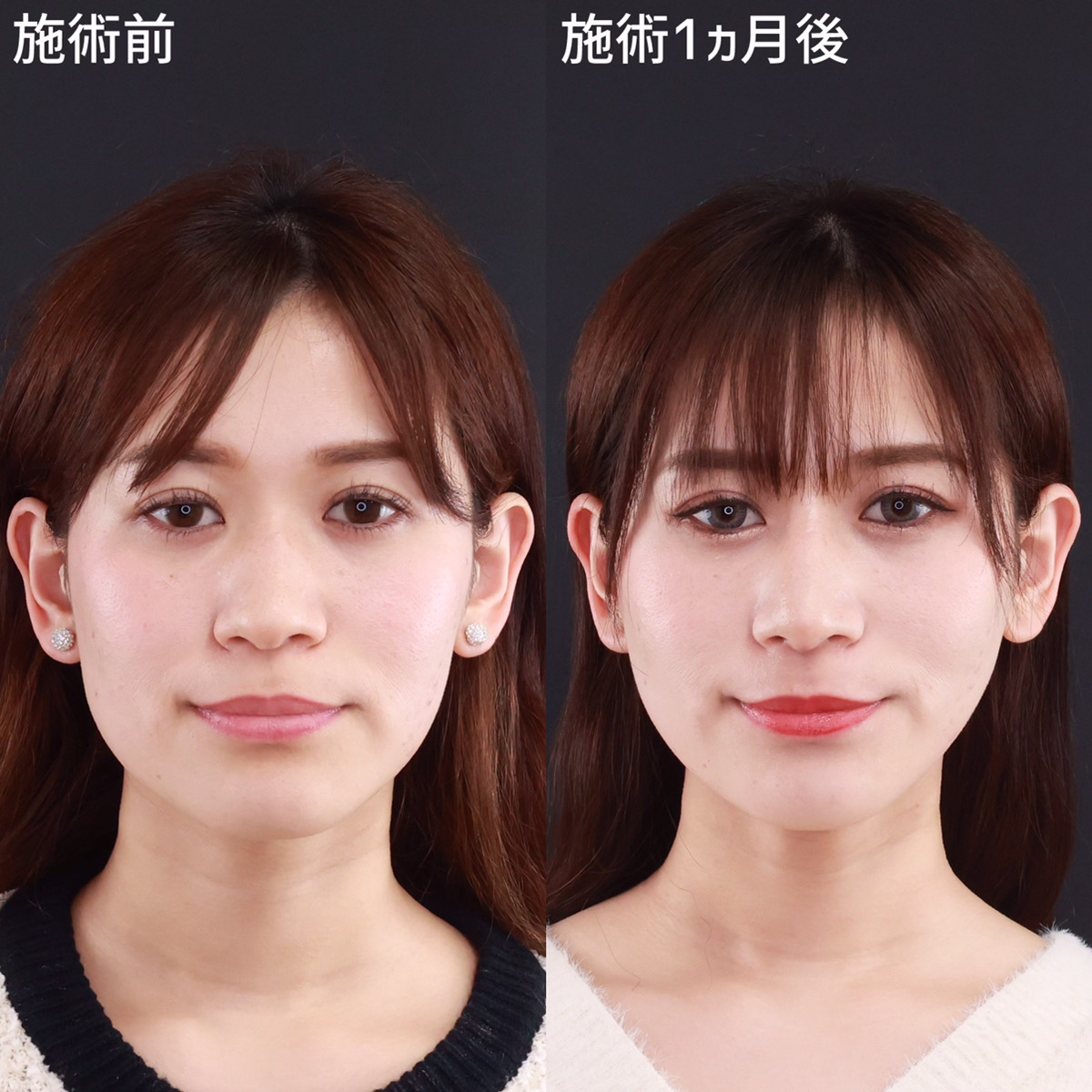 鼻尖形成・鼻尖縮小/鼻先軟骨移植/鼻中隔延長術の症例写真 施術前後 