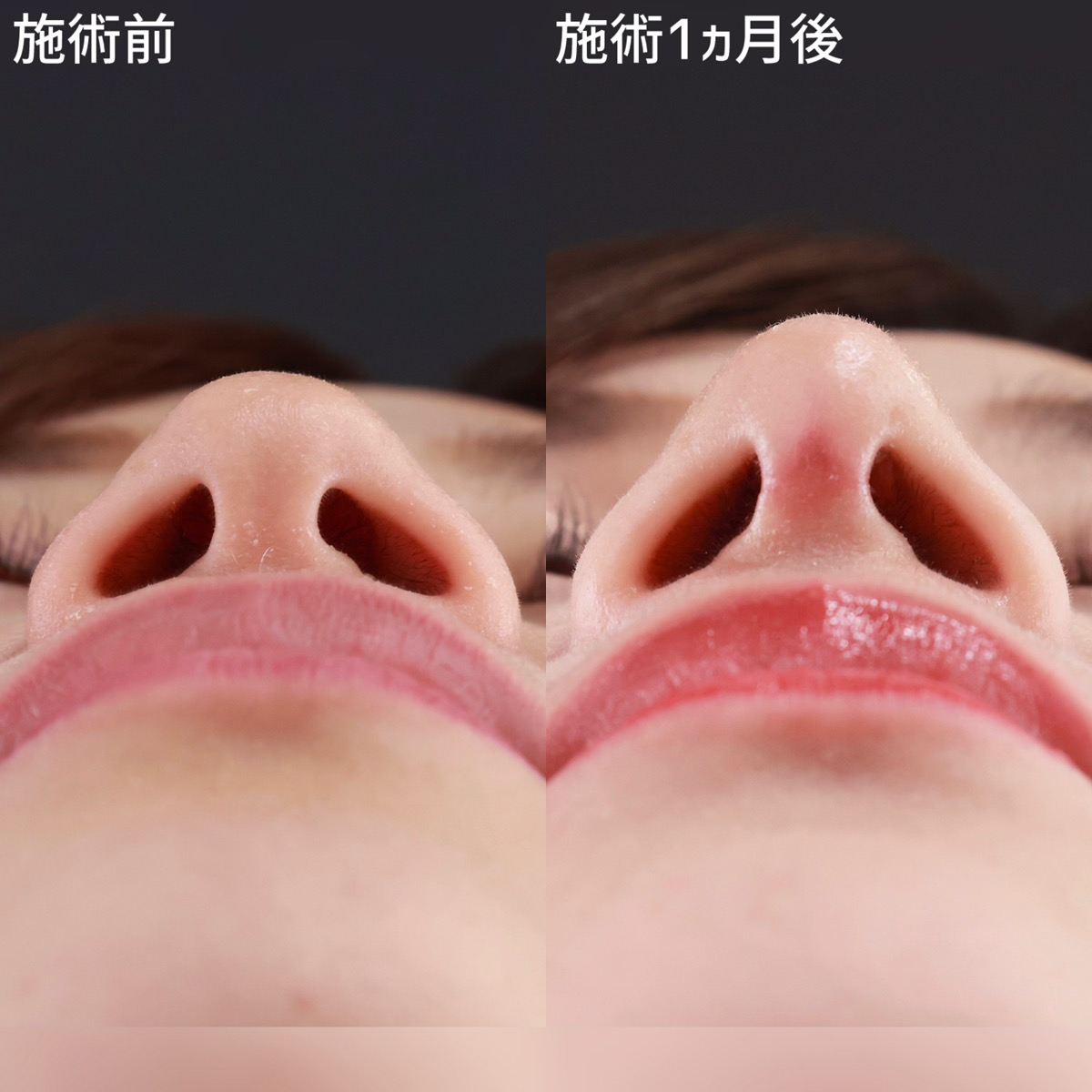 鼻尖形成・鼻尖縮小/鼻先軟骨移植/鼻中隔延長術の症例写真 施術前後 