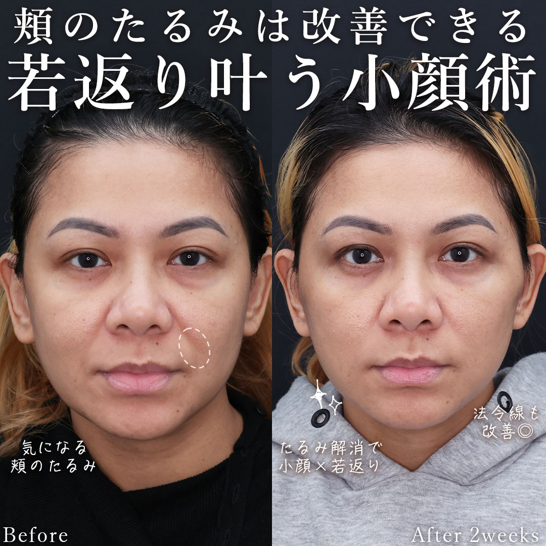 TAC式 ツヤ肌コラーゲンリフト®の症例写真 施術前後 