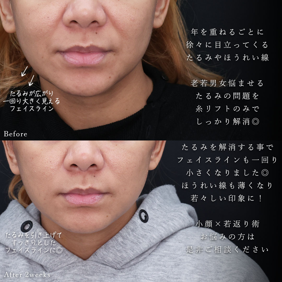 TAC式 ツヤ肌コラーゲンリフト®の症例写真 施術前後 