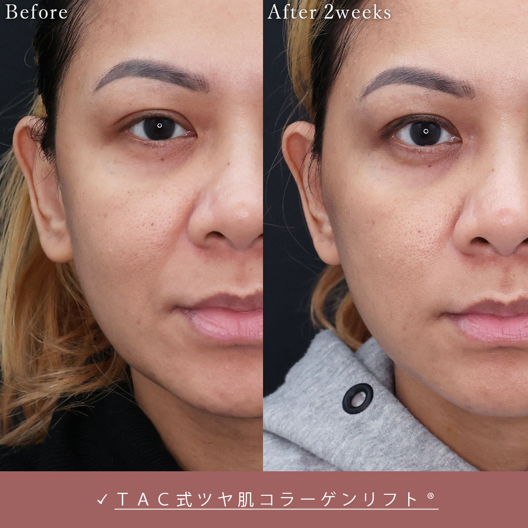 TAC式 ツヤ肌コラーゲンリフト®の症例写真 施術前後 