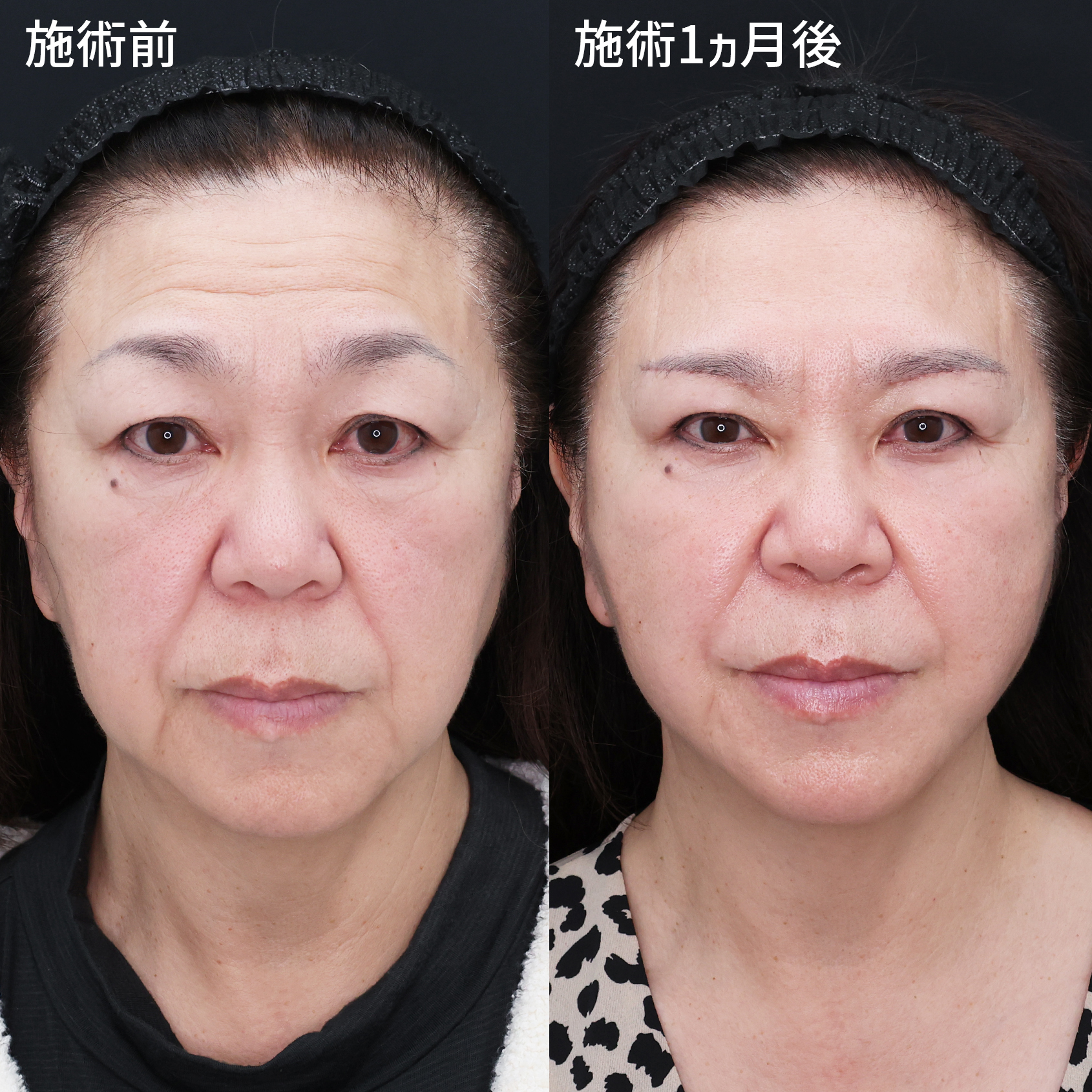 【目元、輪郭】たるみの改善で若返り！