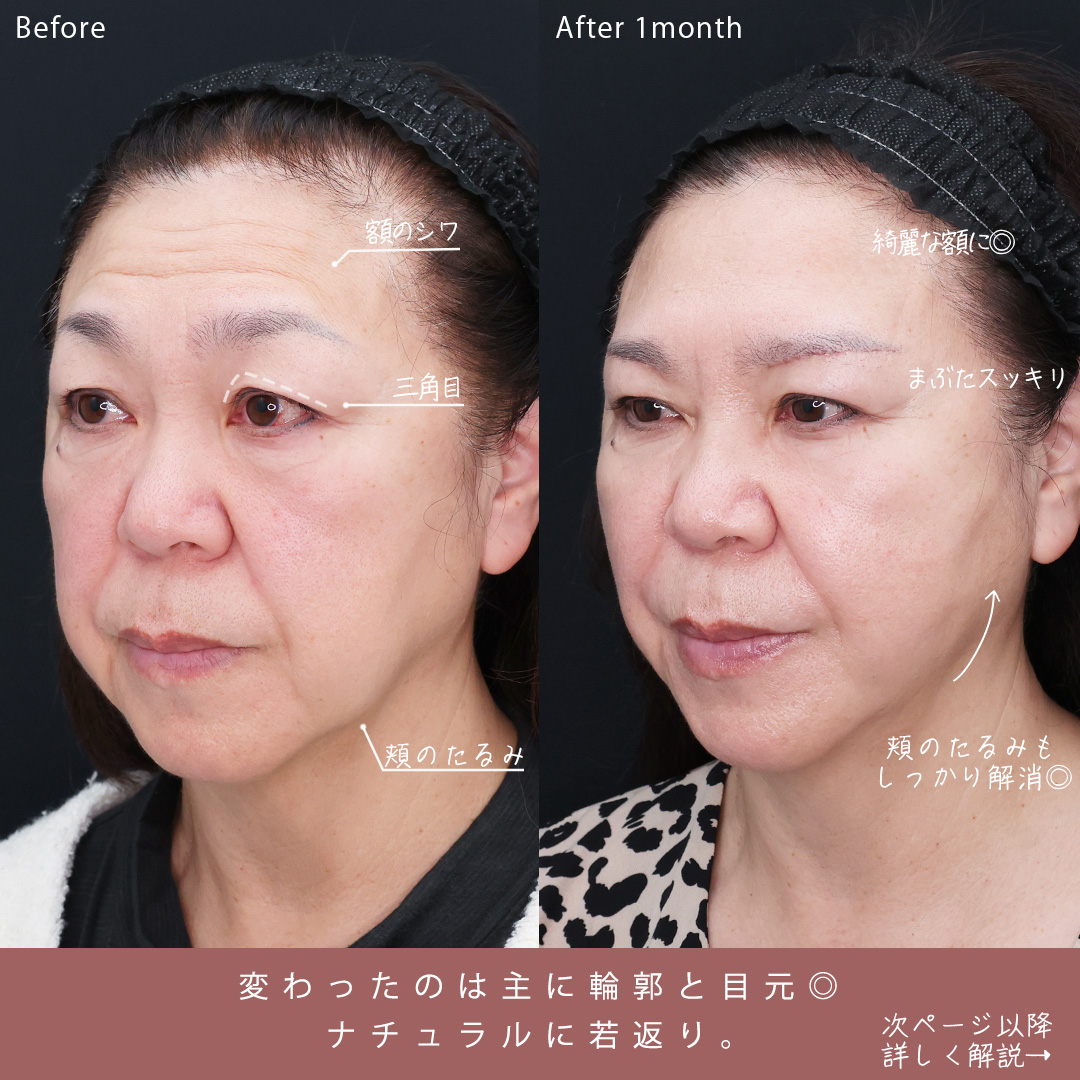 TAC式 ツヤ肌コラーゲンリフト®/眉毛下切開術/ほうれい線のヒアルロン酸注射の症例写真 施術前後 