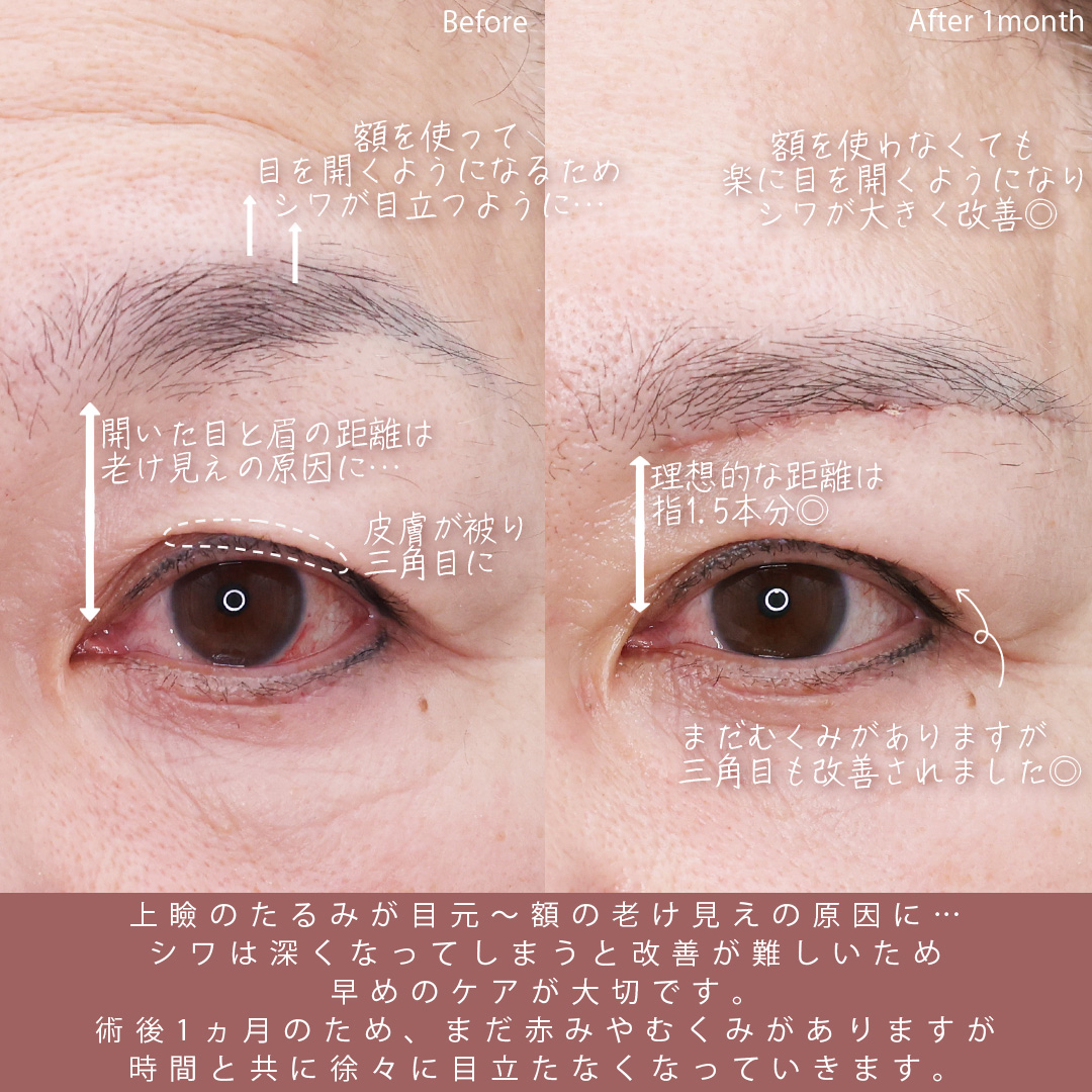 TAC式 ツヤ肌コラーゲンリフト®/眉毛下切開術/ほうれい線のヒアルロン酸注射の症例写真 施術前後 