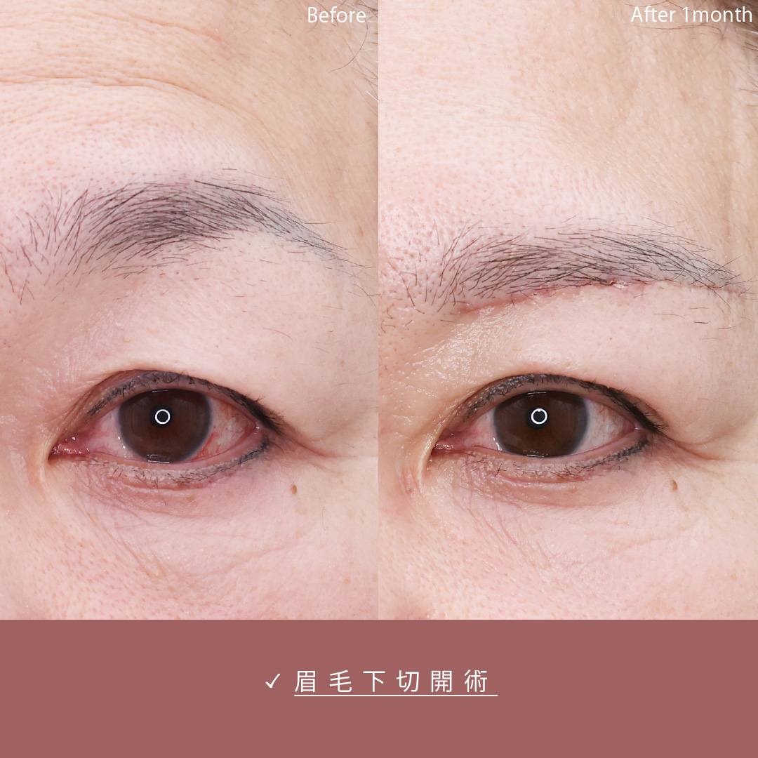 TAC式 ツヤ肌コラーゲンリフト®/眉毛下切開術/ほうれい線のヒアルロン酸注射の症例写真 施術前後 