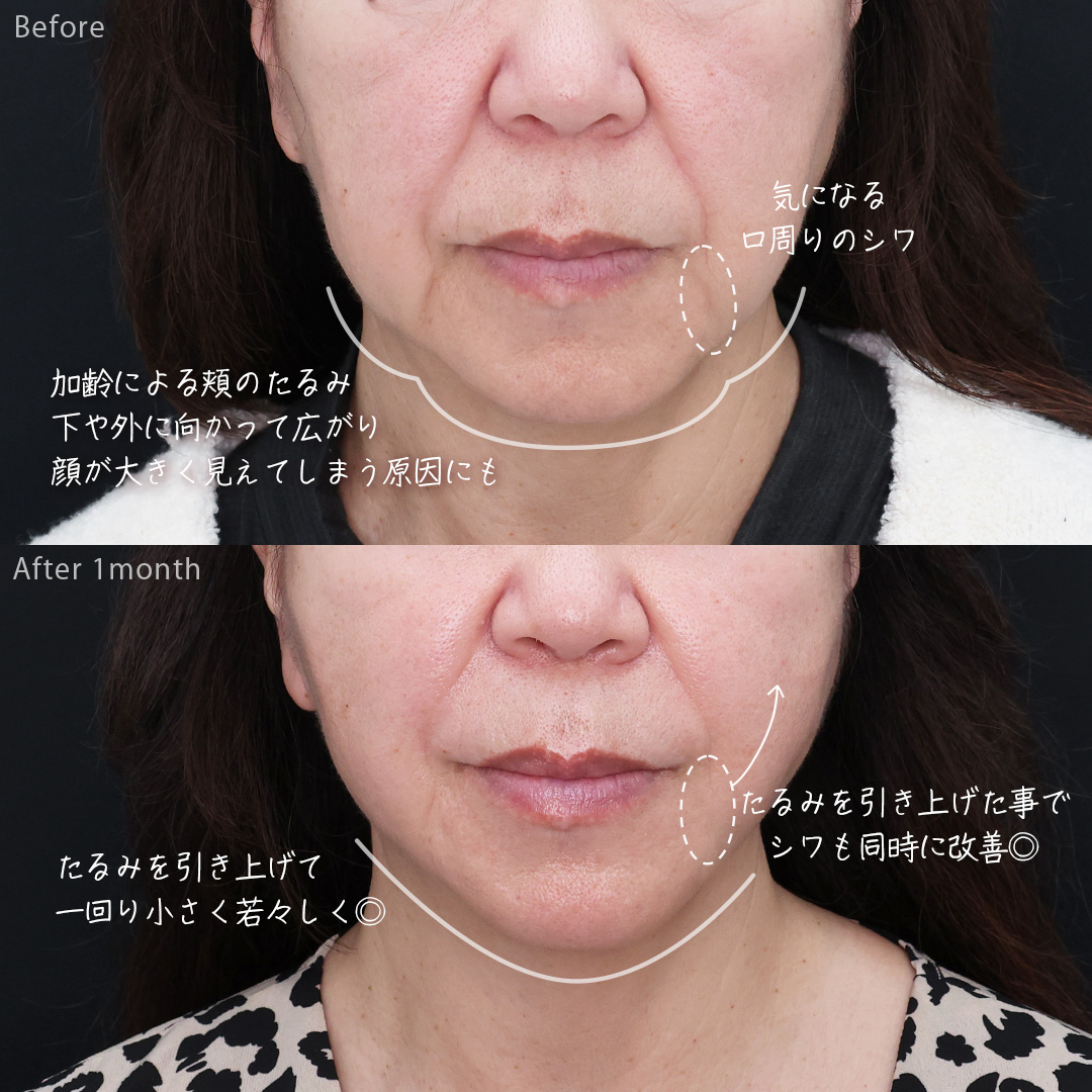 TAC式 ツヤ肌コラーゲンリフト®/眉毛下切開術/ほうれい線のヒアルロン酸注射の症例写真 施術前後 
