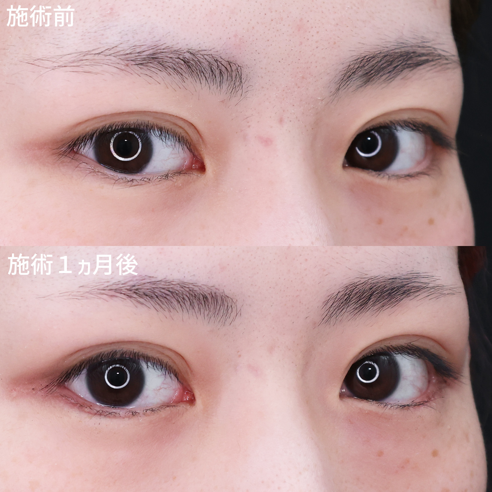 グラマラスライン(タレ目形成)/目尻切開術の症例写真 施術前後
