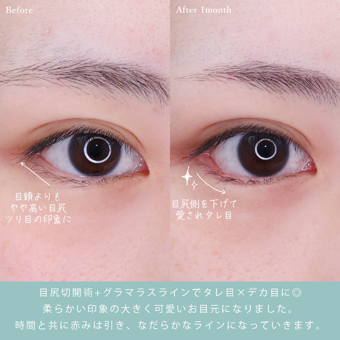 グラマラスライン(タレ目形成)/目尻切開術の症例写真 施術前後