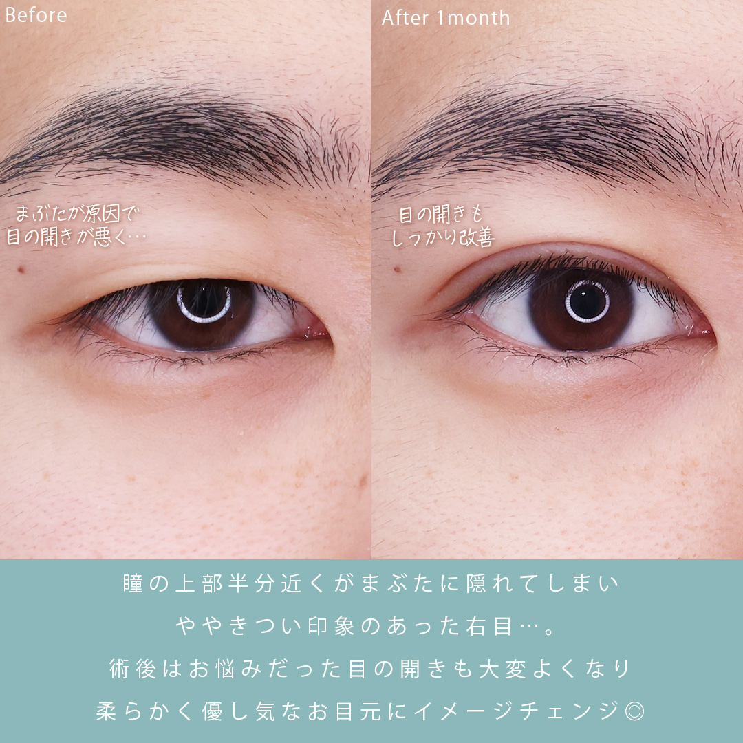 二重埋没法の症例写真 施術前後 