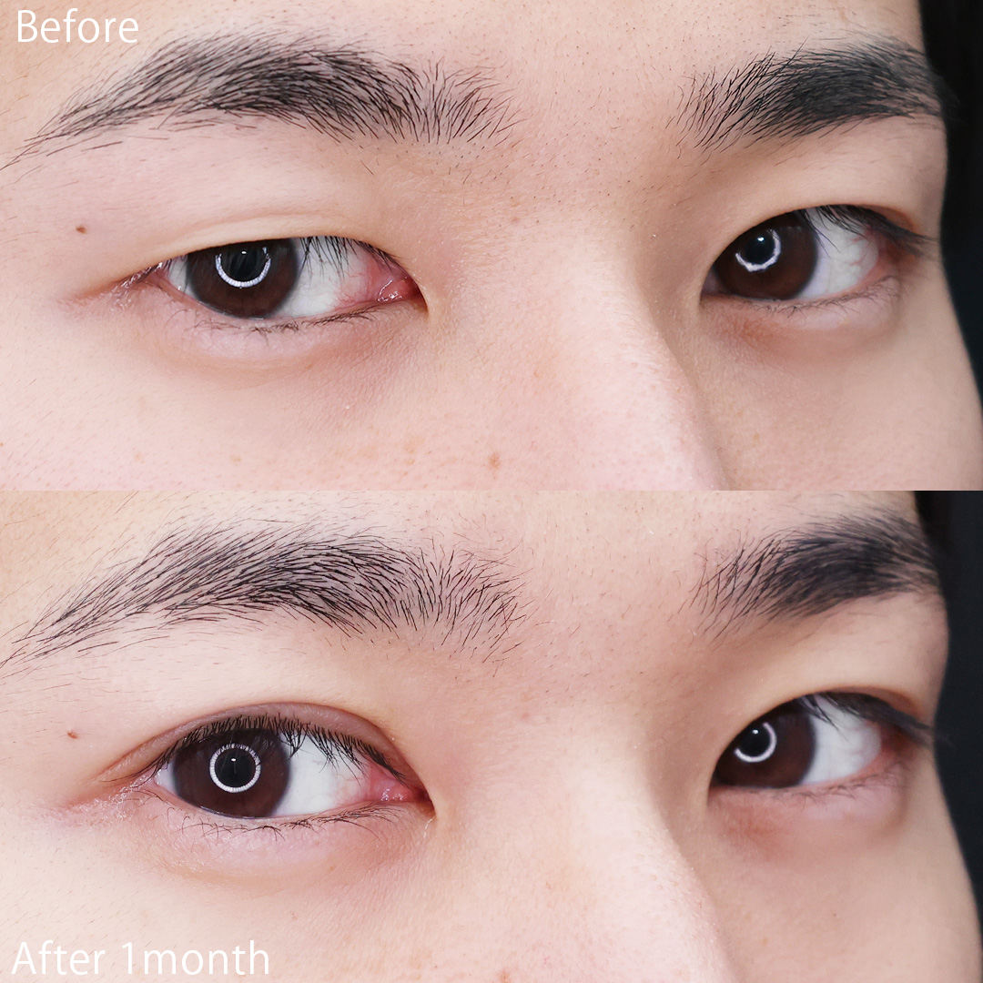 二重埋没法の症例写真 施術前後 