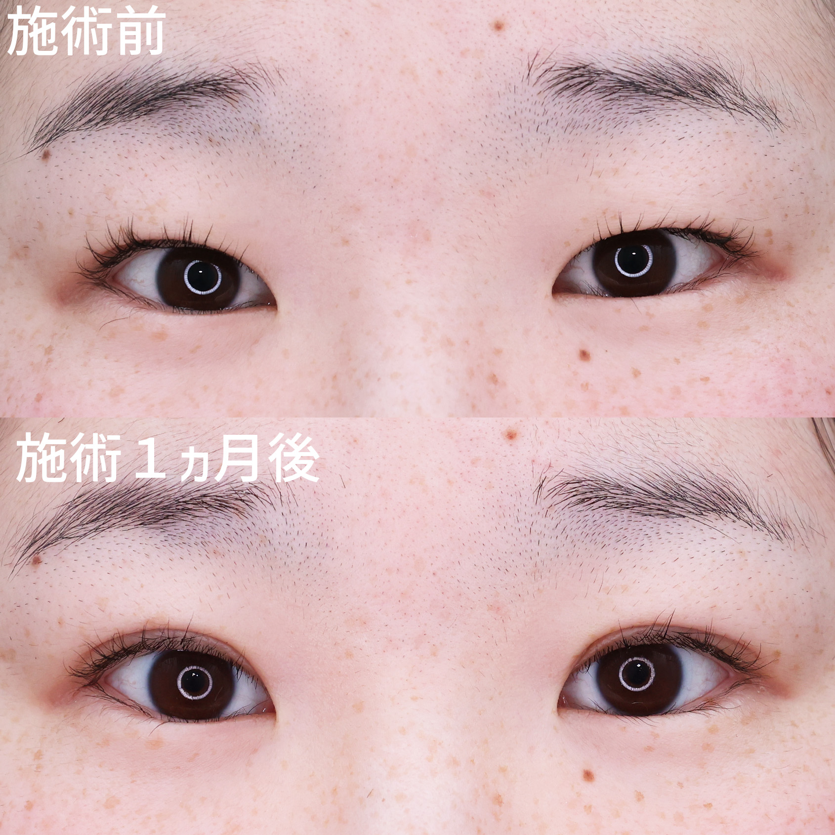 二重埋没法の症例写真 施術前後